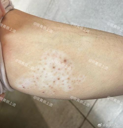 白癜风皮肤病怎么治 成都治疗白癜风有效果的医院 白癜风皮肤病怎么治 成都治疗白癜风有效果的医院