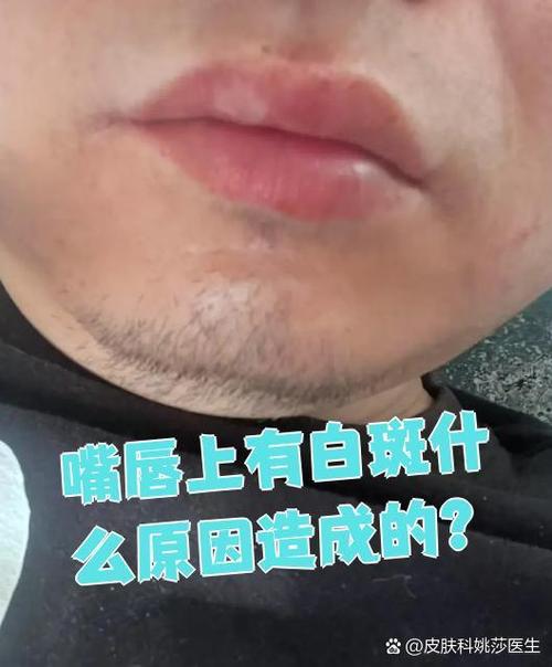 协和医院误诊白癜风 北京协和医院白癜风大夫 协和医院误诊白癜风 北京协和医院白癜风大夫