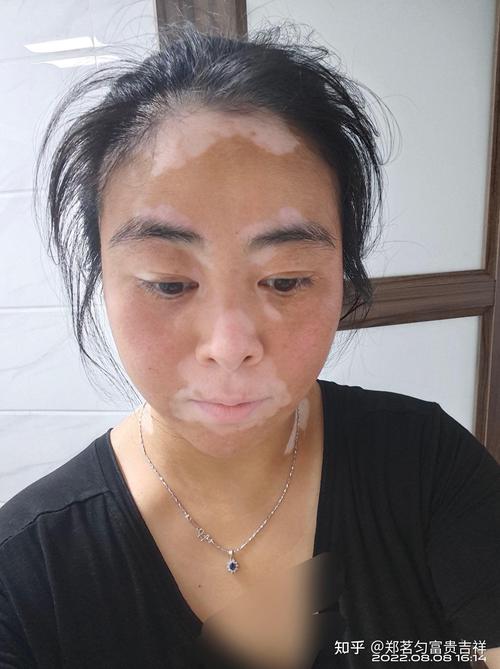 食物治疗白癜风用哪些 食物治疗白癜风用哪些
